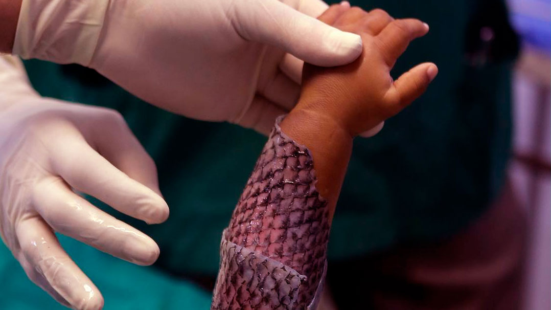 Cientistas brasileiros estão usando pele de tilápia para tratar queimaduras